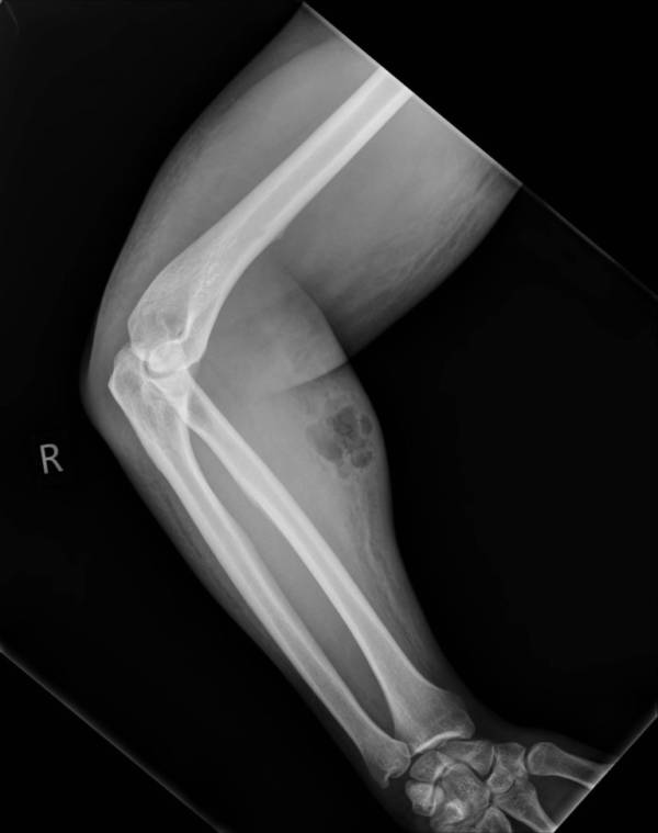 X Ray After Semen Injections