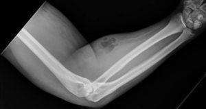 X Ray Following Semen Injections