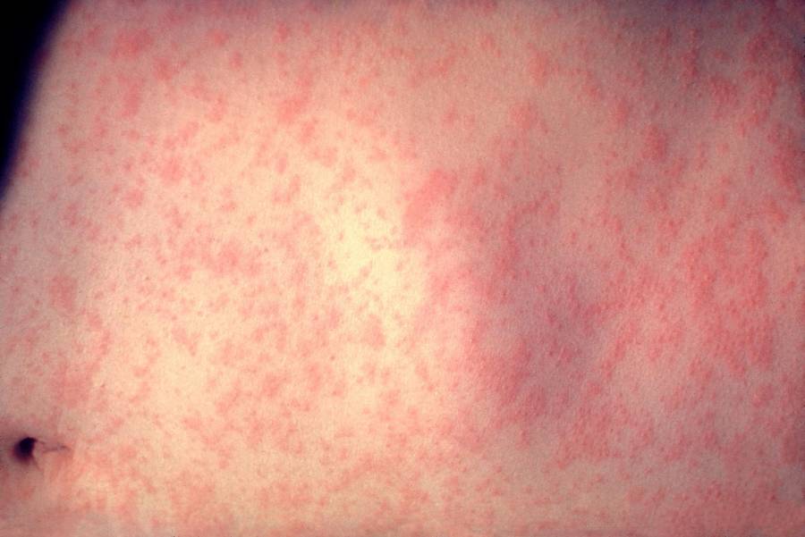 Measles Back After Three Days