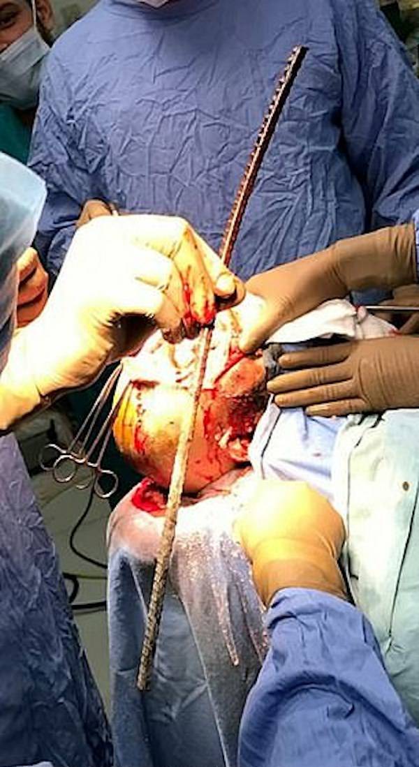 Sanjay Bahe Mid Surgery