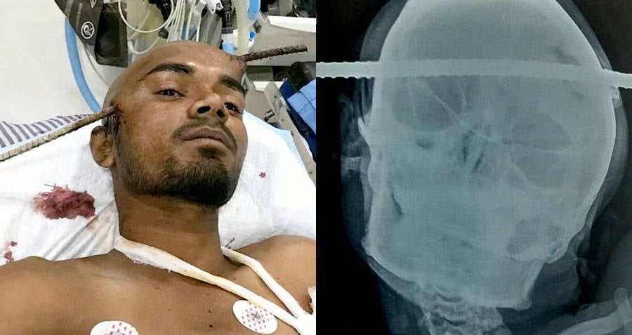 Indian Construction Worker Survives Iron Rod Going Through ...