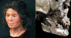 FULL FACE AND SKULL RECONSTRUCTION