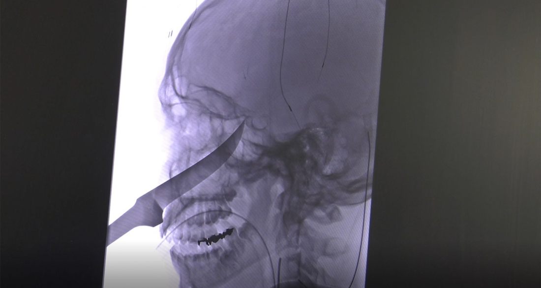 This Lucky Kansas Teen Survived A 10Inch Knife Impaling His Face