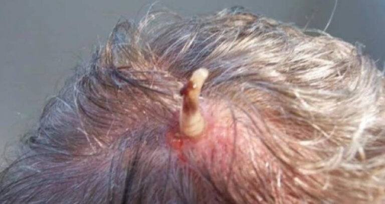 Botfly Coming Out Of Man's Head