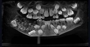 Indian Boy Teeth Xray