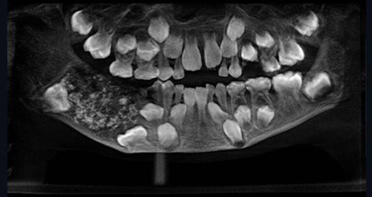 Indian Boy Teeth Xray