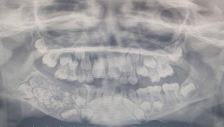 X Ray Of 526 Teeth