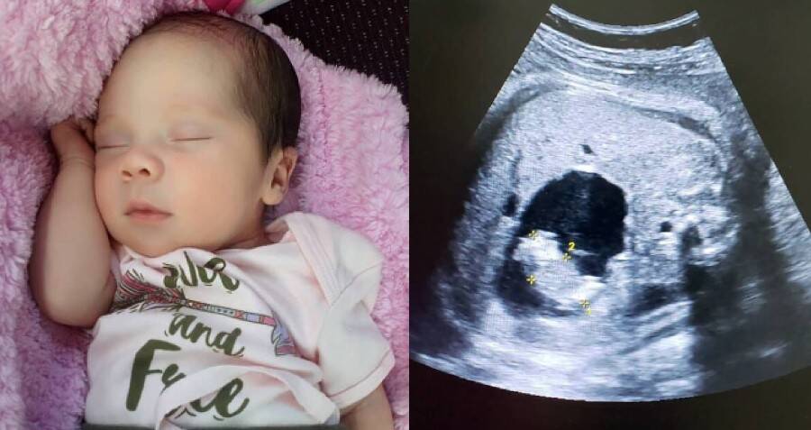 A Baby Was Born 'Pregnant' With Her Own Twin And Needed A...