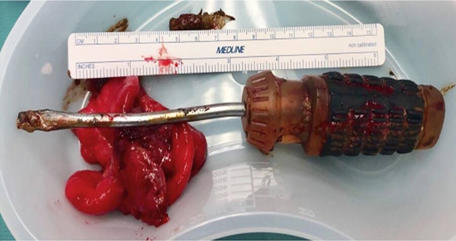 Image result for US Doctors Remove 8-inch Screwdriver From Man's Rectum"