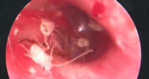 Cockroaches Inside Patient's Ear