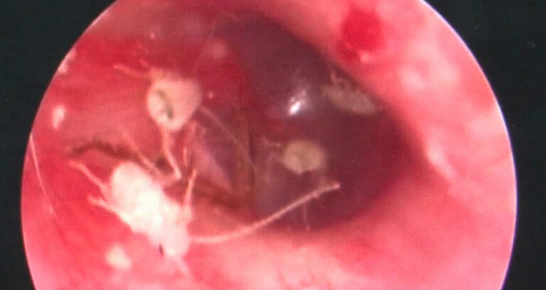 Cockroaches Inside Patient's Ear