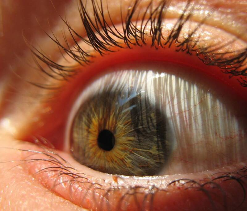 parasites in humans eyes