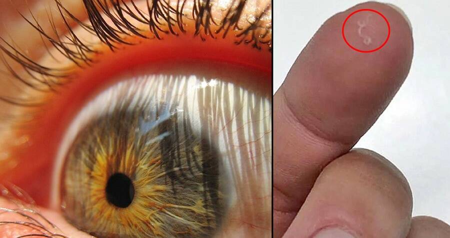 parasites in humans eyes