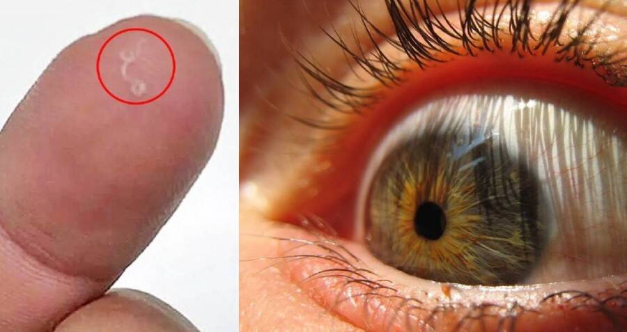 parasite worm in eye