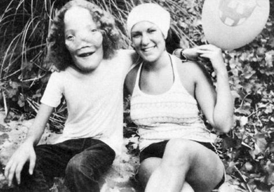 stuiten op Soldaat kraai Rocky Dennis: The True Story Of The Boy Who Inspired 'Mask'