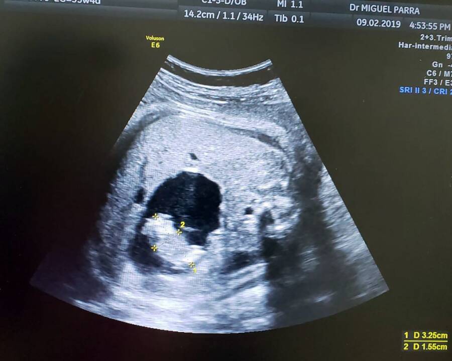 Ultrasound Scan Of Itzmara In The Womb