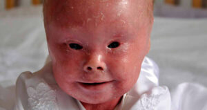 Baby With Harlequin Ichthyosis