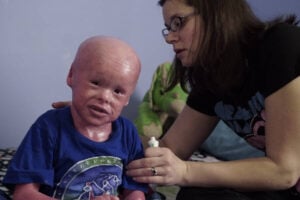 Harlequin Ichthyosis: Photos And Stories Of The Rare Skin Disease