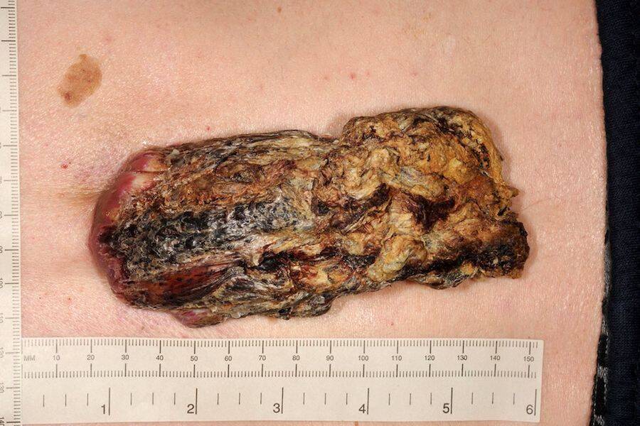 Cutaneous Horn And Measuring Stick