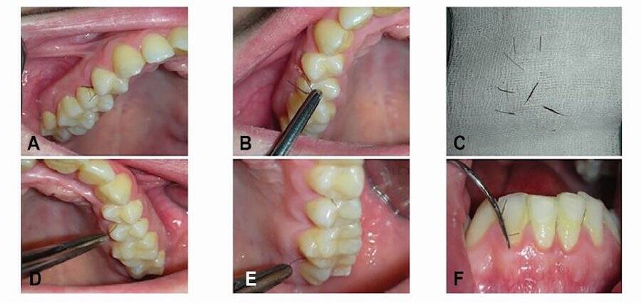 Patient With Gingival Hirsutism