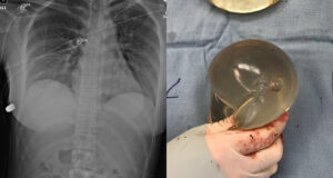 X Ray Vs Removed Implant