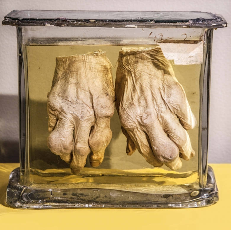 Gout Hands Jar