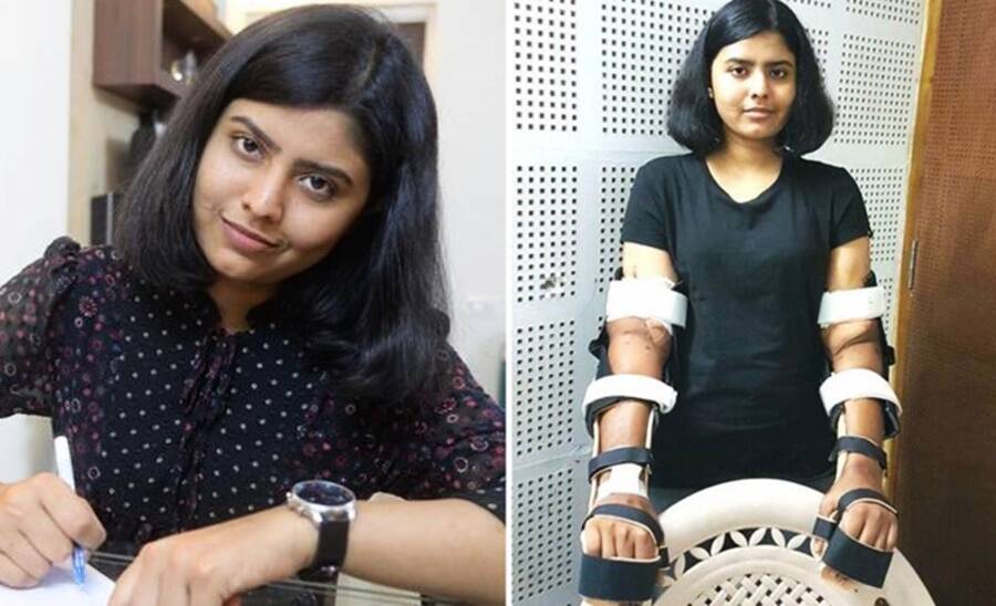 Shreya Siddanagowder Hand Transplant Science News