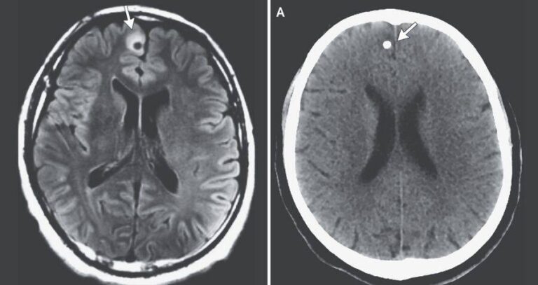Brain Tapeworms Ct And Mri Scans