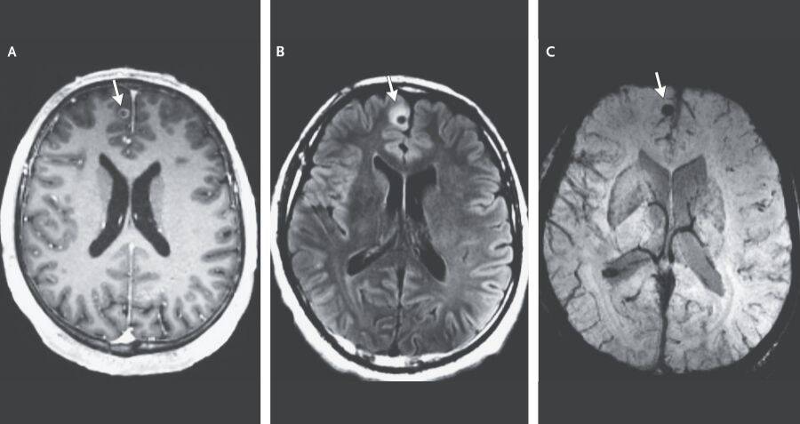 A Boston Man Started Having Mysterious Seizures &mdash; Then Doctors Discovered A  Decades-Old Tapeworm In His Brain