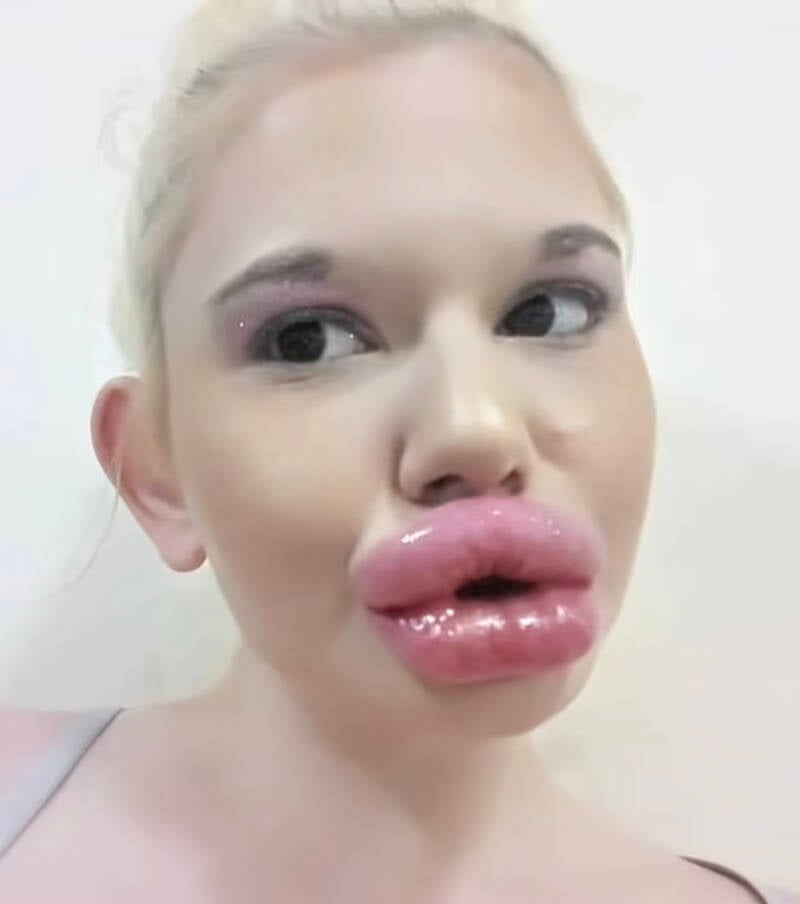Andrea Ivanova With World's Biggest Lips