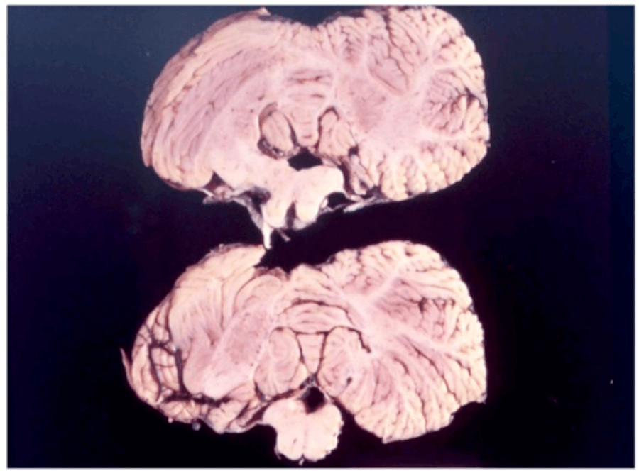 Brain Of Kuru Victim