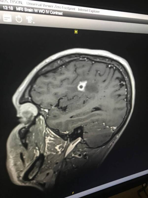 Black Mold Brain Scan