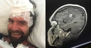 Tyson Bottenus Brain Fungus