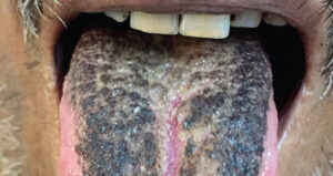 Black Hairy Tongue With Teeth