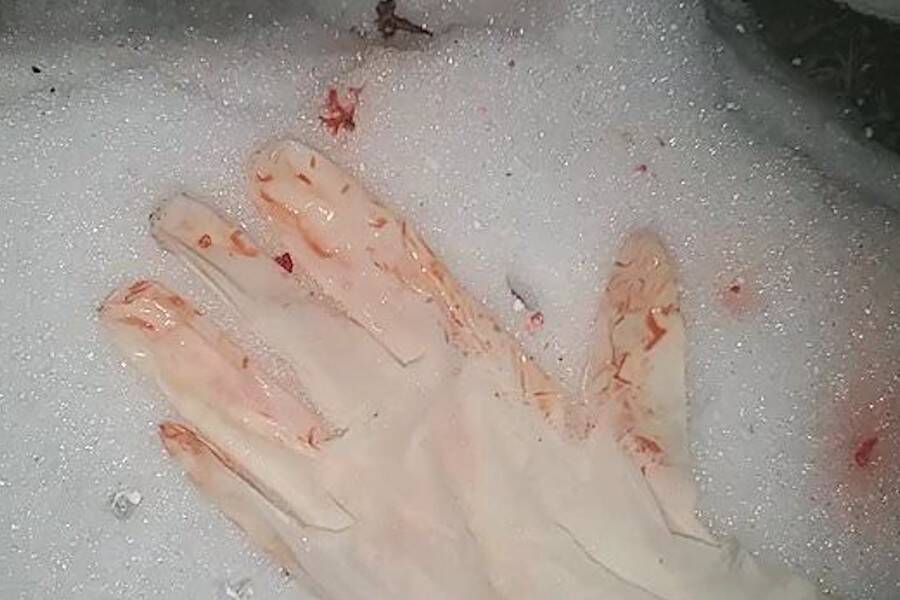 ถุงมือศัลยแพทย์เปื้อนเลือดท่ามกลางหิมะ