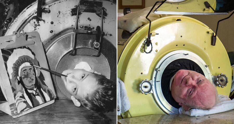 Paul Alexander, The Man Who Lived In An Iron Lung For 72 Years