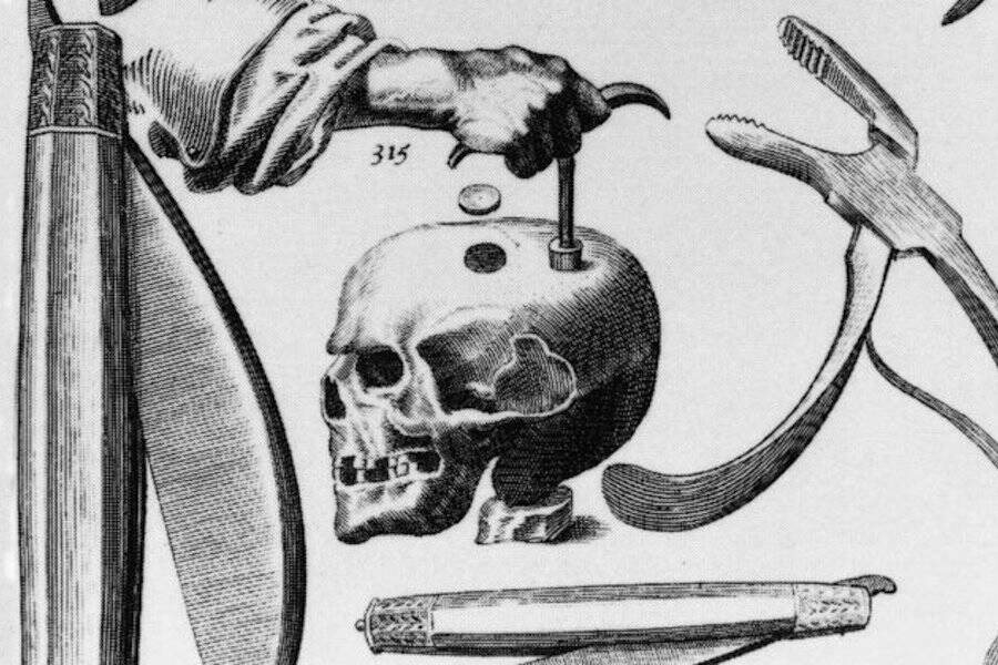 Illustration Of Trepanation Process
