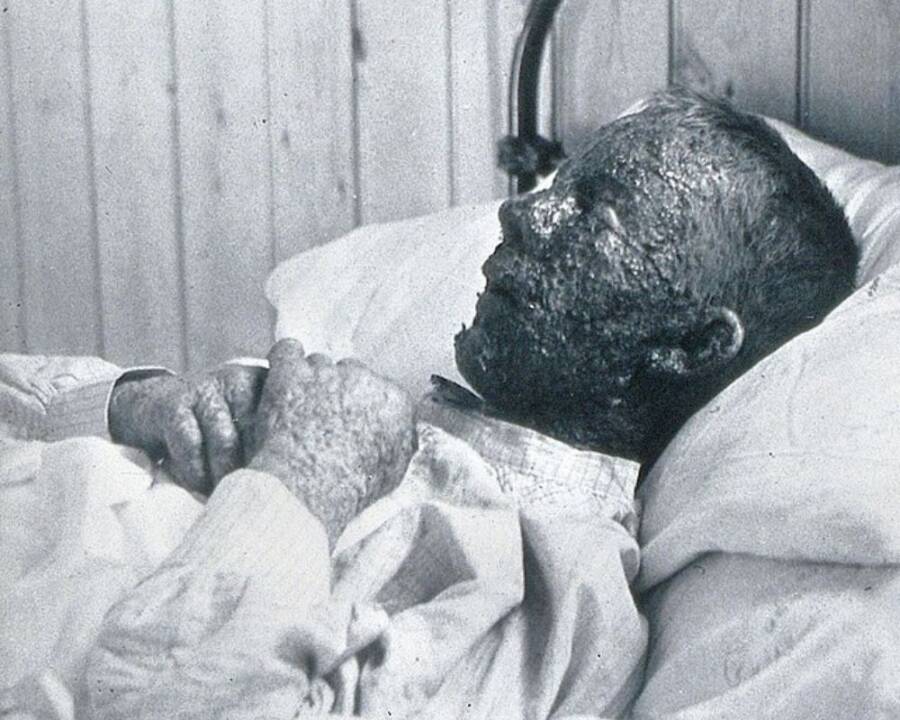 Smallpox Victim