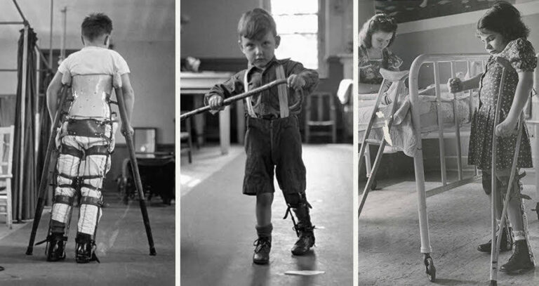 Three Views Polio Victims