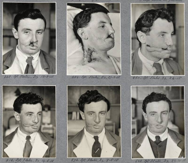 Harold Gillies: The Surgeon Who Rebuilt The Faces Of WW1 Veterans