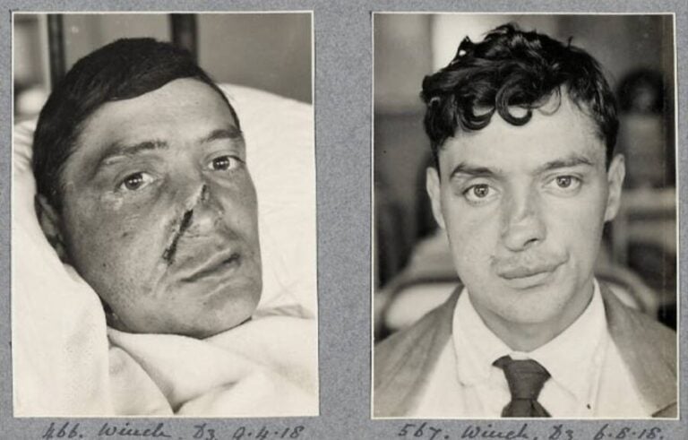 25 Incredible Before-And-After Photos Of Disfigured WW1 Soldiers Who ...