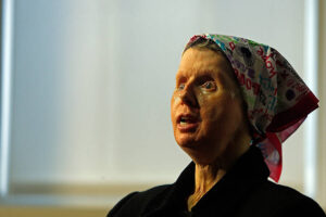 Charla Nash, The Woman Who Lost Her Face To Travis The Chimp