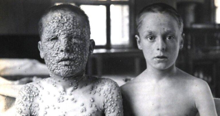 One Boy With Smallpox And One Without