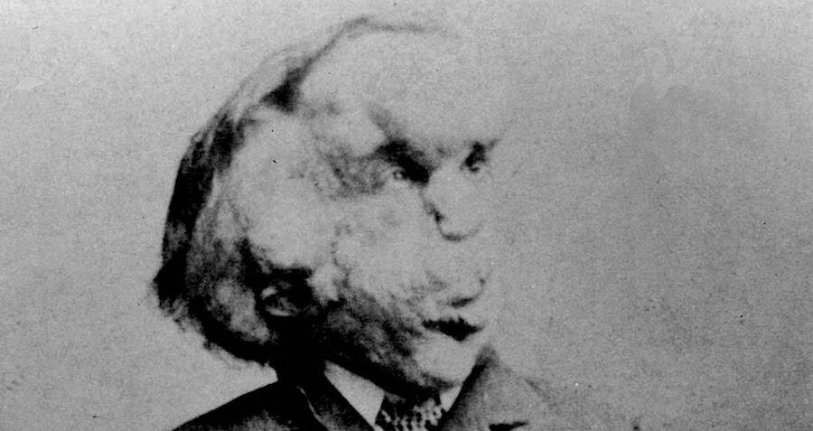 Joseph Merrick Facial Portrait