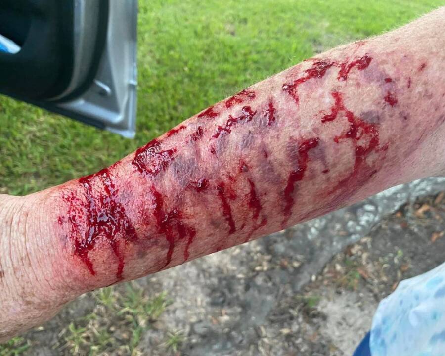 Bloody Arm