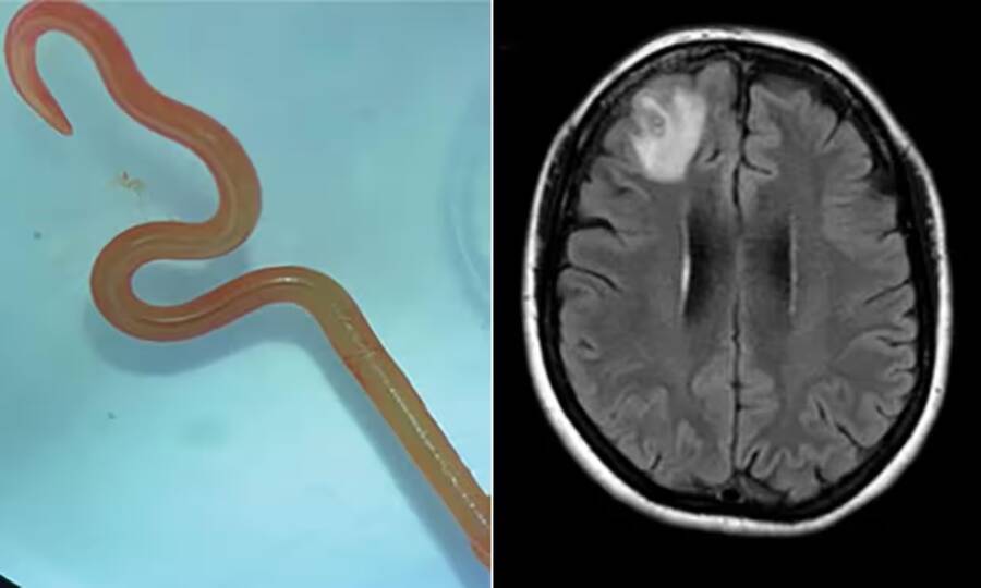 Roundworm In Woman's Brain
