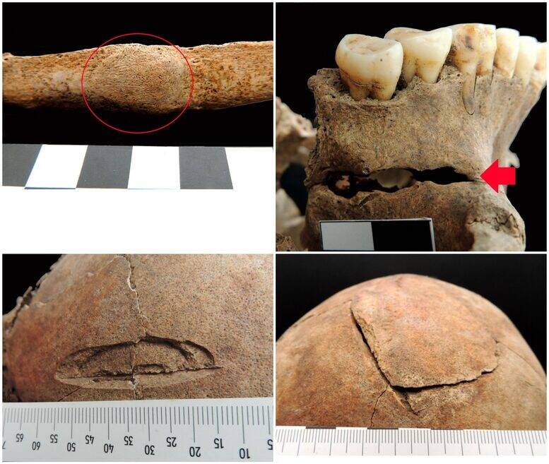 Injuries On Croatian Vampire Skeleton