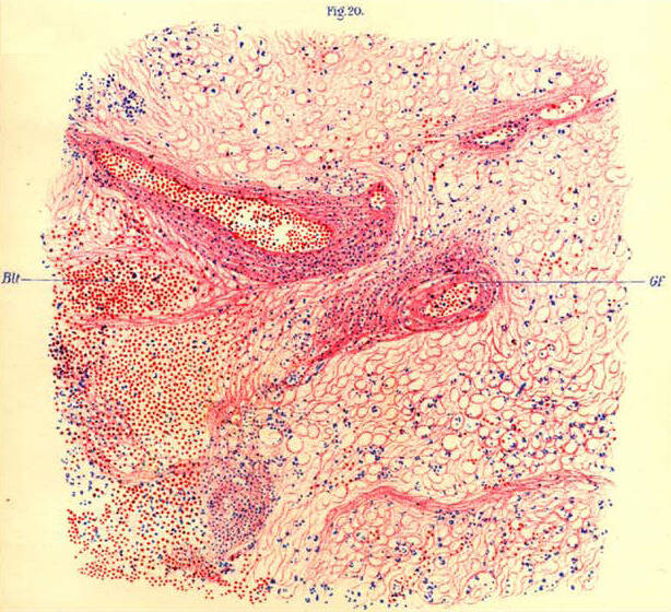 Encephalitis Lethargica Illustration