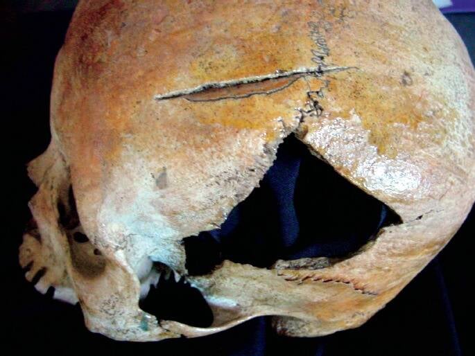Tuol Sleng Skull Trauma
