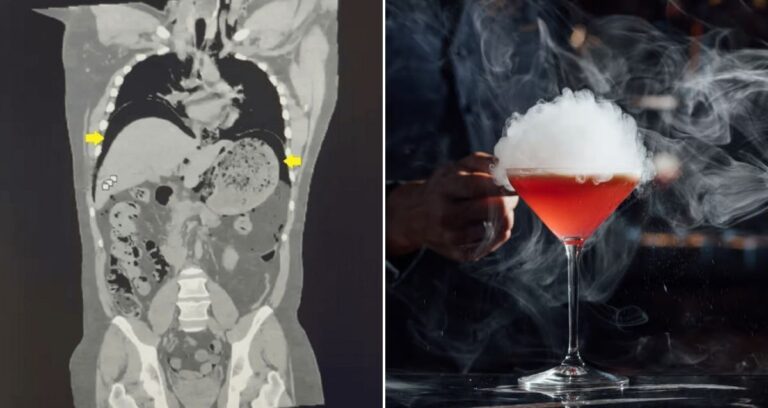 Nitrogen In Abdomen Alongside Liquid Nitrogen Cocktail Featured
